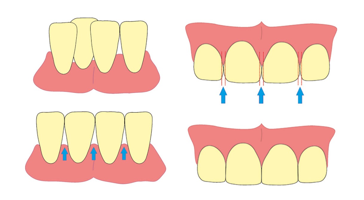 IPR Burs Kit 